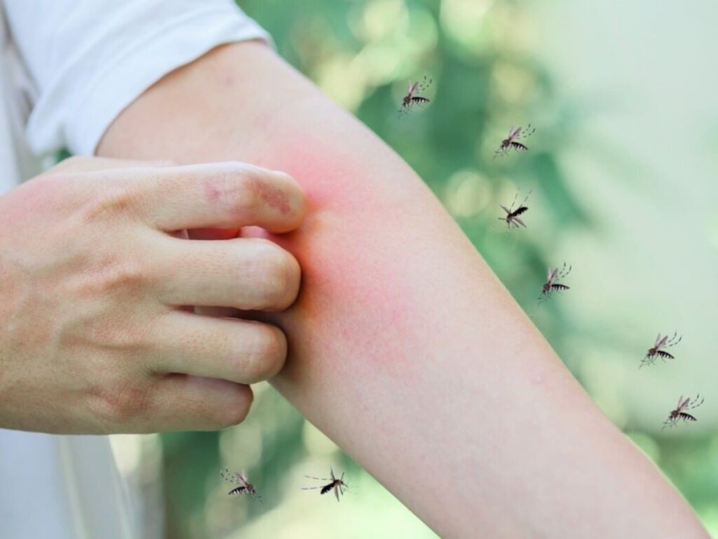 Itchy from Mosquito Bites? Discover This Effective Remedy!